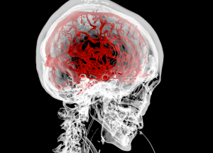 medical_plugin_brain_vessel_from_CT