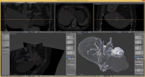 medical_plugin_liver_from_CT